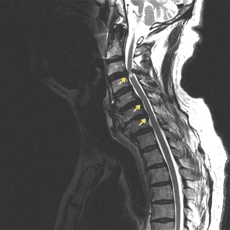 spinal cord compression diagnostic tests|how does spinal compression happen.